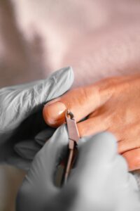 Treating an Ingrowing Toenail with Minimal Patient Stress